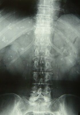 胸椎圧迫骨折X線像1
