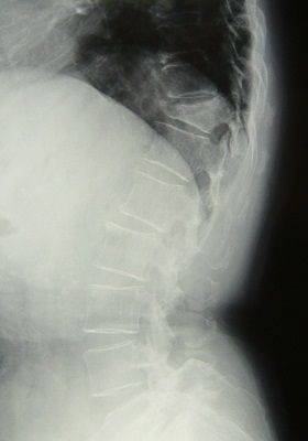 胸椎圧迫骨折X線像2