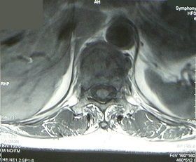 胸椎圧迫骨折MRI画像2
