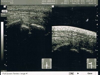 仙尾骨境界部骨折超音波画像