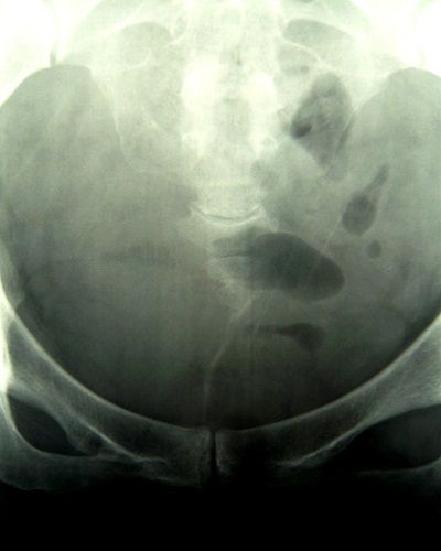 仙尾骨境界部骨折X線像1