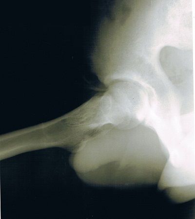 右下前腸骨棘剥離骨折X線像1（受傷直後）