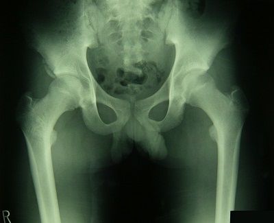 右下前腸骨棘剥離骨折X線像1（受傷後7週）