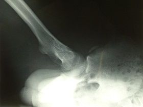 右下前腸骨棘剥離骨折X線像2（受傷後7週）