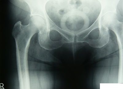 右恥骨骨折（骨盤骨折）X線像1