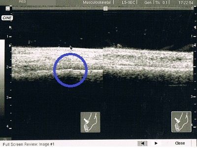 右足第4中足骨疲労骨折超音波画像