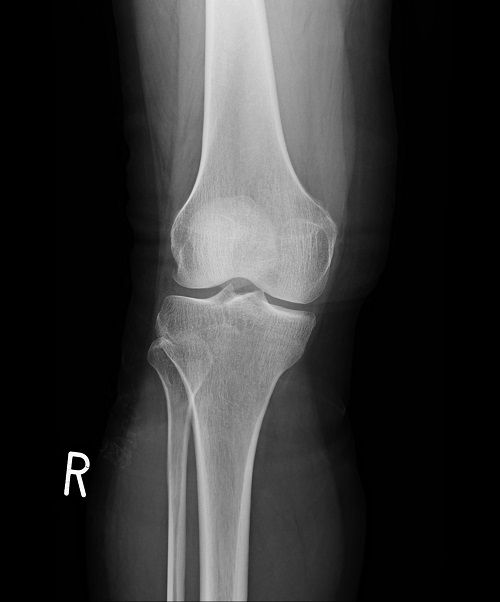 後十字靭帯の脛骨付着部剥離骨折X線像1（受傷直後）