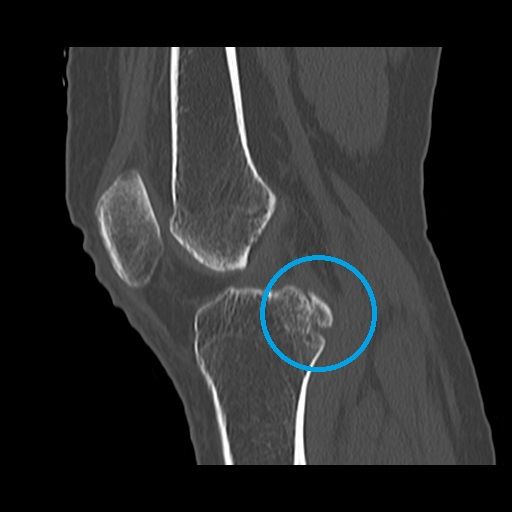後十字靭帯の脛骨付着部剥離骨折CT画像（受傷後8週経過）