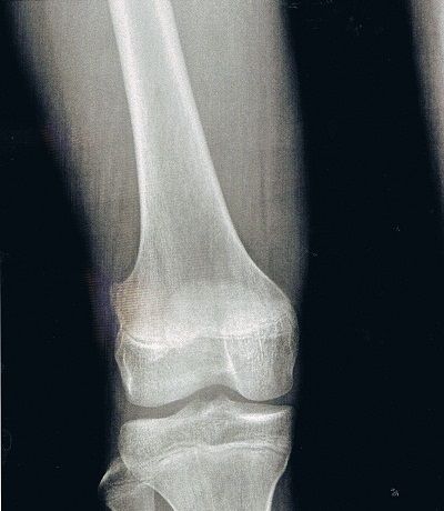右大腿骨外骨腫X線像