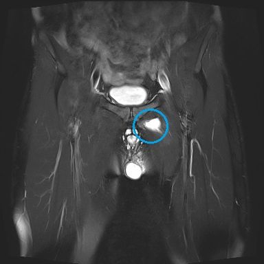 股関節内側の内転筋または恥骨筋筋断裂 MRI画像1