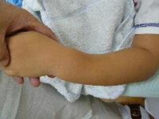 小児の不安定（整復困難）な前腕骨両骨骨折 受傷直後