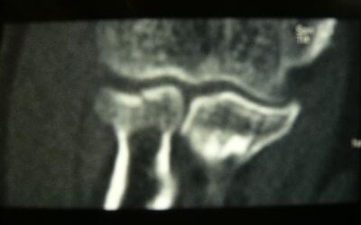右橈骨頭骨折 CT画像