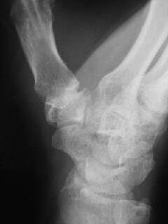 大菱形骨骨折 X線像2