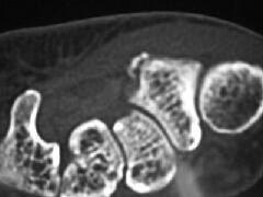 大菱形骨骨折 CT画像1