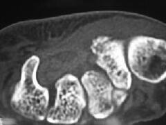 大菱形骨骨折 CT画像3