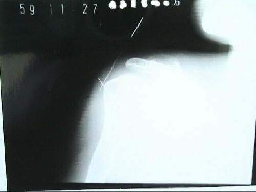 石灰沈着性腱板炎X線像2