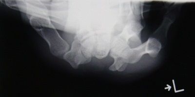 舟状骨骨折X線像2