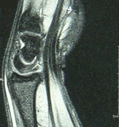 舟状骨骨折MRI画像