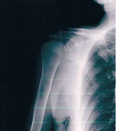 上腕骨大結節骨折X線像（応急処置後）