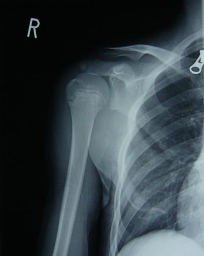 右肩甲骨多発骨折及び上腕骨大結節剥離骨折 X線像