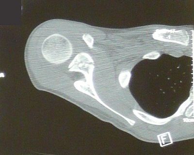 右肩甲骨多発骨折及び上腕骨大結節剥離骨折 CT画像2