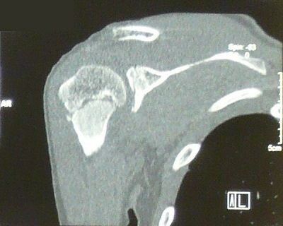 右肩甲骨多発骨折及び上腕骨大結節剥離骨折 CT画像3